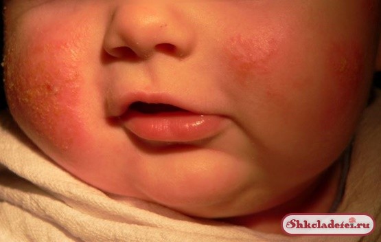 Как вылечить атопический дерматит у ребенка